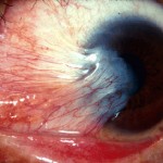 Pterygium_from_Michigan_Univ